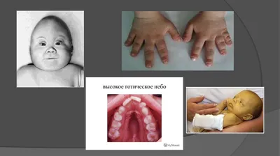 Готическое нёбо: причины, симптомы у детей, диагностика, лечение высокого  аркообразного нёба