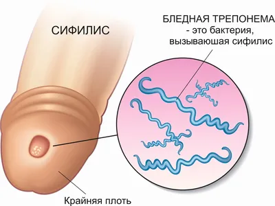 Баланит и баланопостит