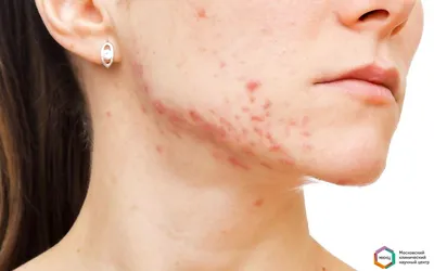 Клиника доктора Куликовича - О каких болезнях символизируют прыщи на лице:  Сыпь на лице может сигнализировать о больных внутренних органах Высыпания  на коже не всегда связаны с проблемной кожей. Сыпь – это