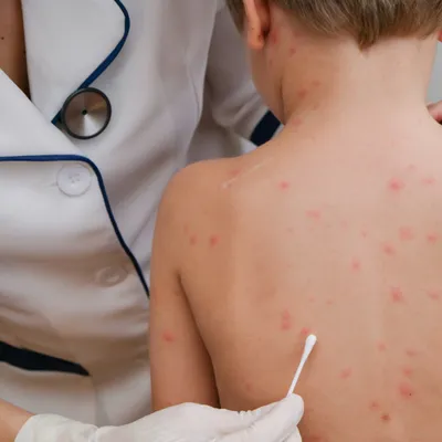 Сыпь на коже у ребенка и температура – к какому врачу обратиться