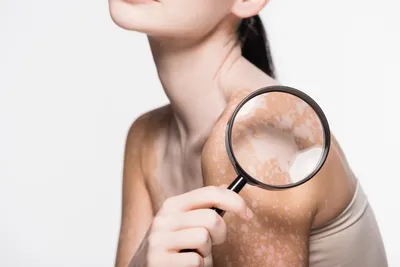 Связаны ли глисты с высыпаниями на коже - Новости здоровья - Здоровье 24