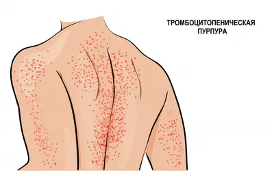 Панкреатит: что это за болезнь, симптомы, признаки, сколько стоит лечение,  обострения, диета