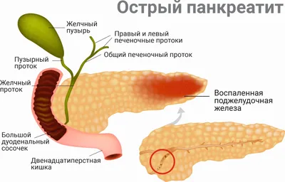 Лечение заболевания поджелудочной железы в Екатеринбурге - Новая Больница