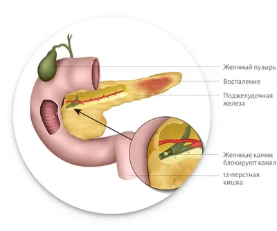 Панкреатит - симптомы и лечение у взрослых, цена в СПб