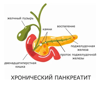 ⚕ Панкреатит: симптомы, причины, лечение ➡ Киев