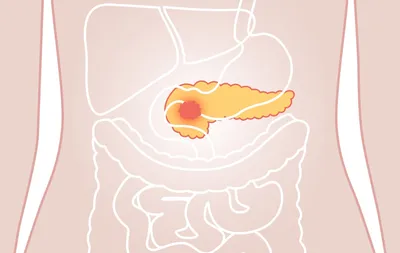Хронический панкреатит - описание, симптомы и лечение / Гастро-гепатоцентр  ЭКСПЕРТ