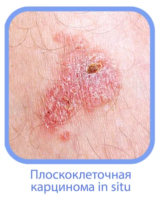 Назван способ определить рак легких по состоянию кожи: Аномалии: Из жизни:  Lenta.ru