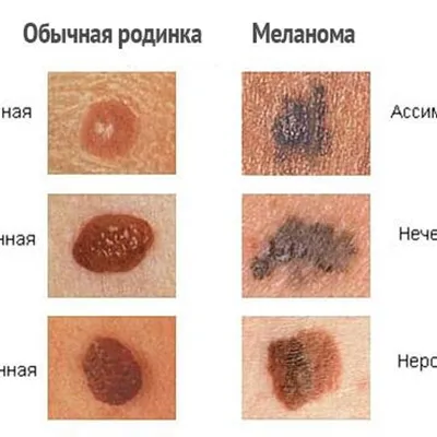 Названы шесть \"кожных\" симптомов рака, требующих срочного обращения к врачу  - РИА Новости, 23.01.2022