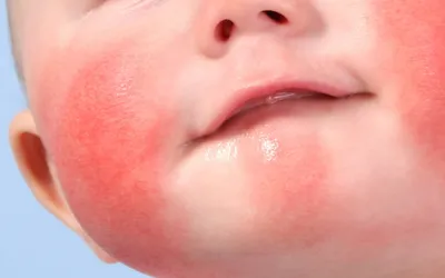 Пищевая аллергия у детей: симптомы у ребенка, лечение пищевой аллергии у  детей
