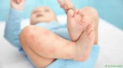 Дерматит у детей - причины, симптомы, диагностика и лечение дерматита у  ребенка | MUSTELA