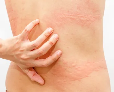 Как распознать контактный дерматит у ребенка: красные кисти рук,  покраснение кожи