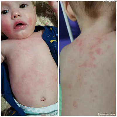 Высыпания на коже у ребенка при дисбактериозе фото фото