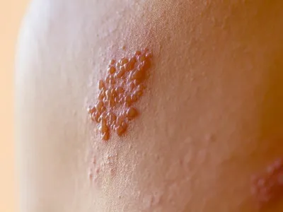 Высыпания на коже: на теле, на лице. Причины и симптомы сыпи на коже