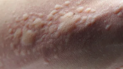 Сыпь на теле - причины, симптомы и лечение высыпаний на коже | Mriya Med
