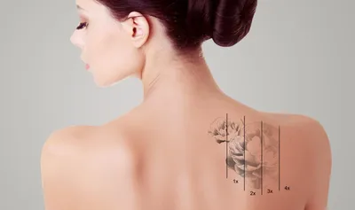 Можно ли убрать татуировку полностью - Tattoobrand.ru