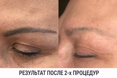 Лазерное удаление тату и перманента - Цены в центрах эстетики и красоты  M-BEAUTY, Санкт-Петербург