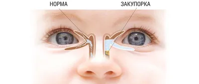 Непроходимость носо-слезного канала у ребенка: симптомы и лечение -  Полезная информация \"Оптик Центр\"