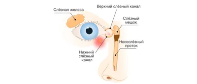 Непроходимость носо-слезного канала у ребенка: симптомы и лечение -  Полезная информация \"Оптик Центр\"