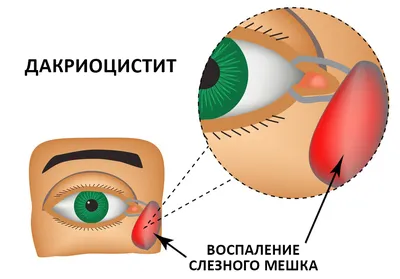 Лечение слезного канала методами остеопатии