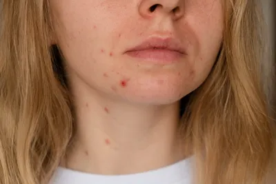 Виды прыщей: причины появления акне (угрей), эффективное лечение заболевания  кожи