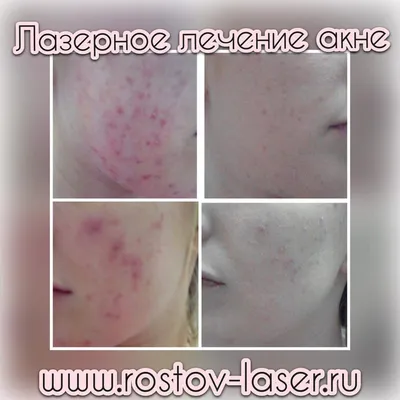 Акне серьёзное заболевание кожи,... - Laško Beauty Company | Facebook