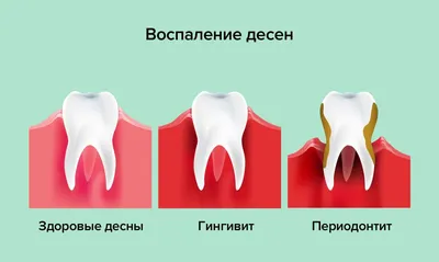 ⚫️Пародонтит - это малоприятное заболевание десен. В запущенной форме он  приводит к расшатыванию зубов и, в дальнейшем, их полной… | Instagram