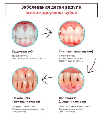 Воспаление десен – лечение, как снять, чем полоскать (лекарство, мазь,  антибиотик)