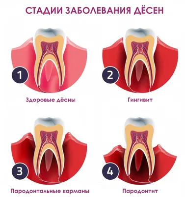 Лечение десен