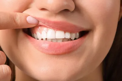 Воспаление зубов (десен) - лечение в стоматологии \"Дента\"