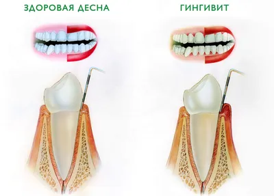 Секреты здоровых десен: как поддерживать их здоровье и предотвращать  заболевания - ВОКА