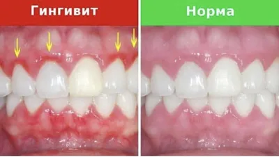 Заболевания десен: гингивит и пародонтоз