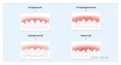 Фото воспаленных десен: симптомы, причины и лечение