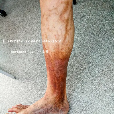 Варикозный (венозный) дерматит на ногах - лечение | Медицинский центр  ФлебоПлюс
