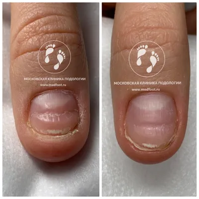 Лечение ногтей СПб. Лечение болезней ногтей в Nail Clinic