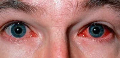 Заболевания глаз фото конъюнктивит лечение народное 83 фото