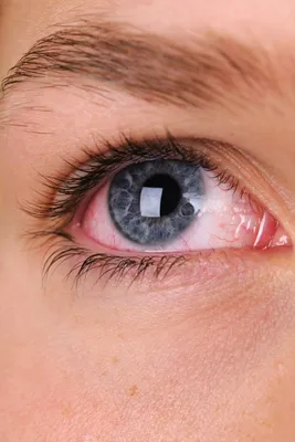 Народные способы в лечении катаракты в домашних условиях - Zrenie.dp.ua