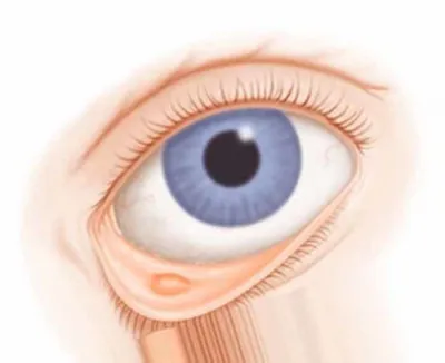 Хемоз конъюнктивы глаза (Отек конъюнктивы) - Clean View Clinic
