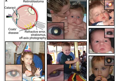 Бесплатное приложение ищет заболевания глаз у детей по фотографиям