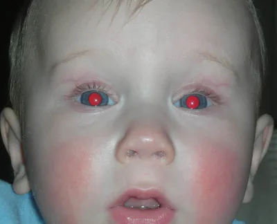 Врожденные заболевания глаз: почему возникают, какие бывают и как  устраняются - Офтальмологические клиники «Эксимер» (Киев) – диагностика и  лечение заболеваний глаз у взрослых и детей