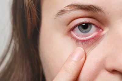 Болезни глаз: виды, причины, симптомы, коррекция | World Vision Clinic