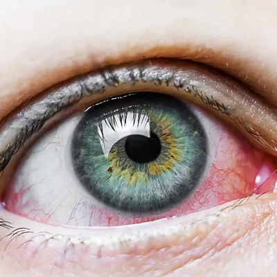 Желтые белки глаз: причины, болезни, методы диагностики лечения