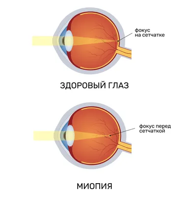 Глазные заболевания у человека список, симптомы - Центр микрохирургии глаза  «Окулюс» - Липецк