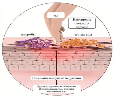 Регрессирующие сосудистые пятна новорожденных