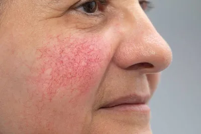 Заболевание кожи Vitiligo стоковое изображение. изображение насчитывающей  пятно - 29466987