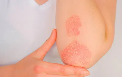 Хронические системные заболевания кожи - Иммунология - Ключевые  терапевтические области - Наши инновации | AbbVie