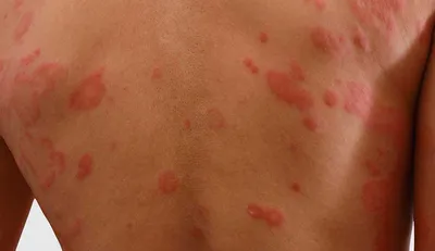 Псориаз: хроническое заболевание кожи - Institut Català del Peu