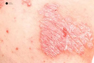 Что такое аутоиммунные заболевания кожи? | Точка Начала | Дзен