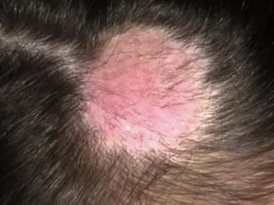 Болезни кожи головы: причины, последствия и лечение - Beauty HUB