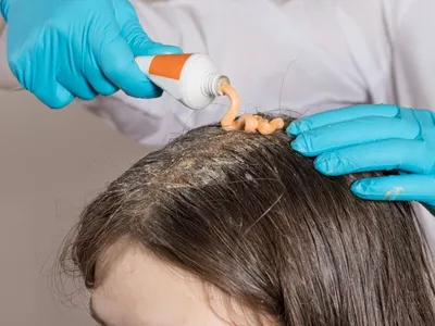 Себорея кожи головы у взрослых и детей: причины и лечение | Клиника Меди  Лайф