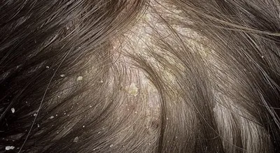 Грибковые болезни на гладкой коже и на волосистой части головы